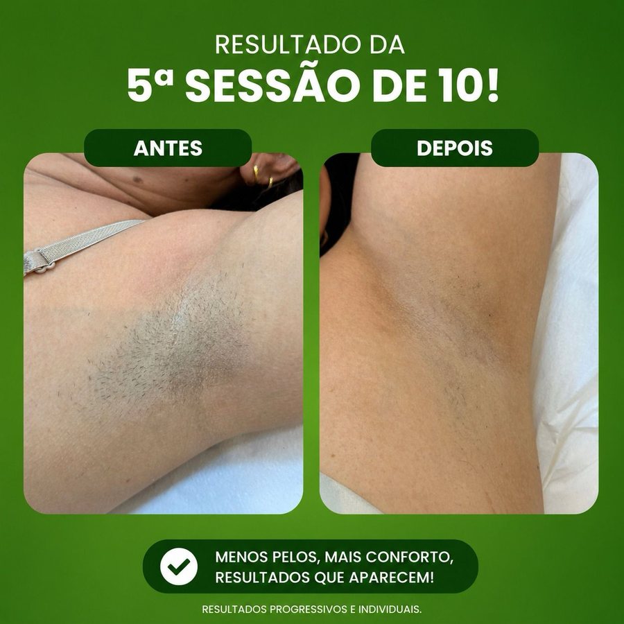 Resultado de depilação a laser após 5 sessões